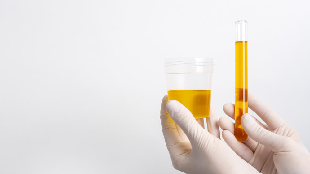 Urobilinogen In Urine Test & Example Free PDF Download